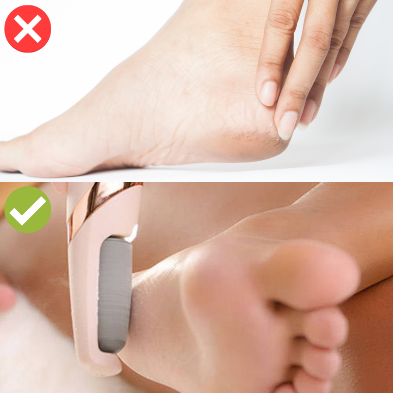 Removedor de Calos e Rachaduras