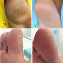 Removedor de Calos e Rachaduras