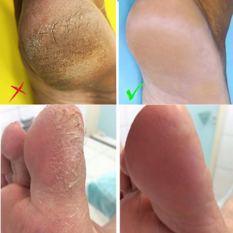 Removedor de Calos e Rachaduras